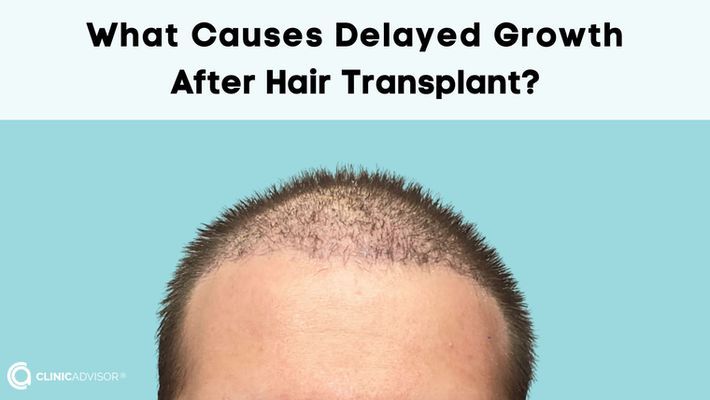 What Causes Delayed Growth After Hair Transplant?