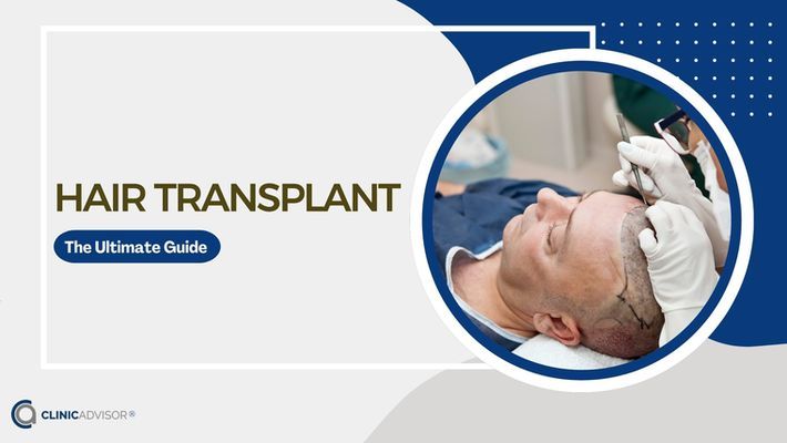 The Ultimate Guide to Hair Transplant