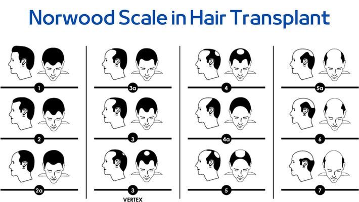 The Norwood -Hamilton Scale in Hair Transplant