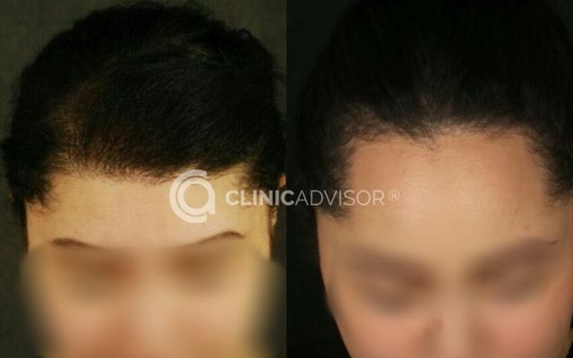 Female Hair Transplant