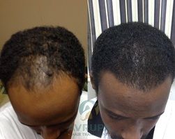 Afro Hair Transplant in Istanbul: FUE Nuances, Surgeon Expertise & 11-Month Results