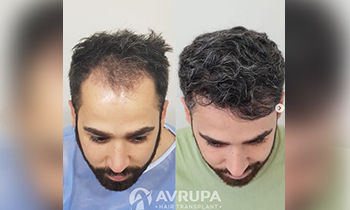 A New You in 2025: Save 50% on Our Premier Hair Transplant Package